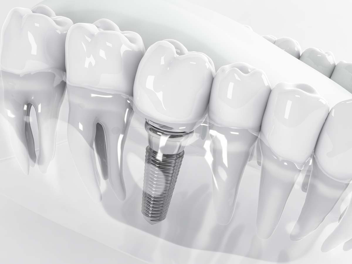 Zahnimplantat