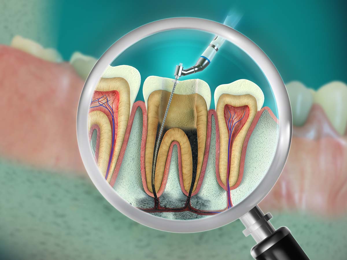 Endodontie / Wurzelbehandlung